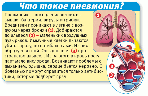 Как лечить начальную стадию пневмонии у ребенка Как лечить начальную стадию пневмонии у ребенка