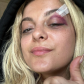 Биби Рекса госпитализирована с травмой после запущенного на концерте в ее лицо телефона