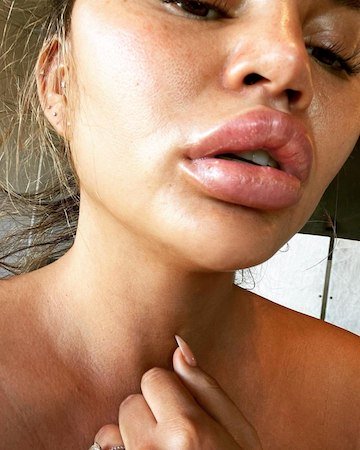 Крисси Тейген пострадала из за обычного апельсина: губы модели распухли до ужасающего размера