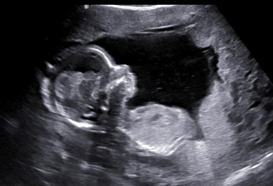 Джесса Даггар беременна четвертым малышом после ужасного выкидыша в 2020 м году!
