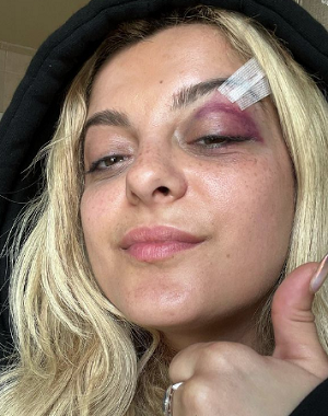 Биби Рекса госпитализирована с травмой после запущенного на концерте в ее лицо телефона - 1