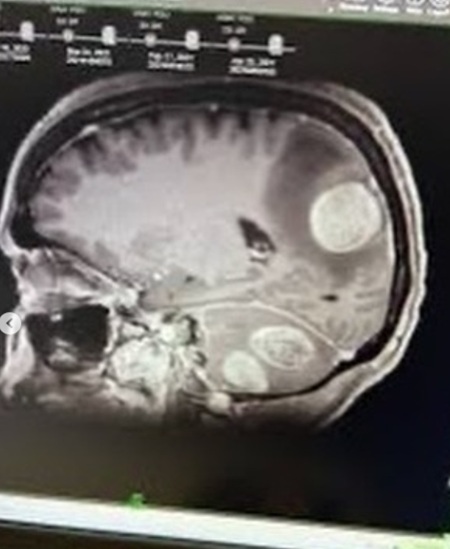 Тедди Мелленкамп борется с раком мозга четвертой стадии