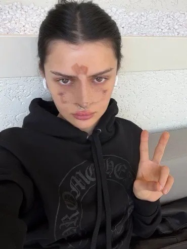 «Сделано!» – 26-летняя Дина Саева показала лицо после ринопластики - 1 Дина Саева