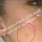 У Хлои Кардашьян осталась огромная вмятина после удаления меланомы на щеке: фото